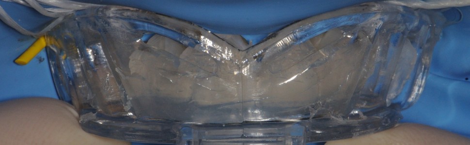 Odbudowa zębów przednich szczęki z wykorzystaniem transparentnego indeksu silikonowego