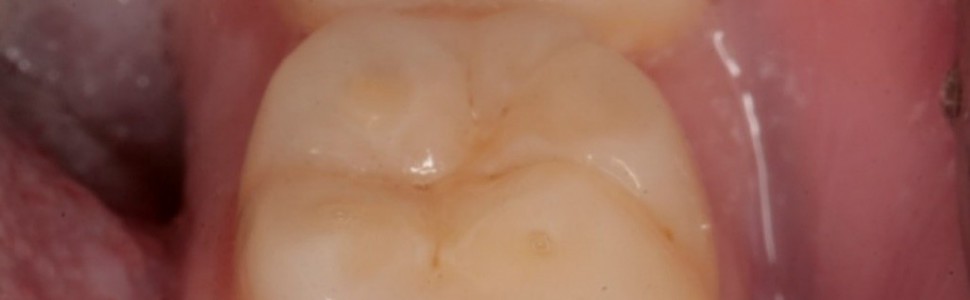 Ubytki erozyjne wśród młodzieży – etiologia, obraz kliniczny i profilaktyka na podstawie piśmiennictwa i własnych obserwacji