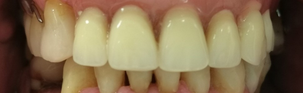 Leczenie starcia patologicznego zębów z wykorzystaniem materiału kompozytowego w przypadku kompleksowej rehabilitacji protetycznej  z odbudową utraconej wysokości zwarcia