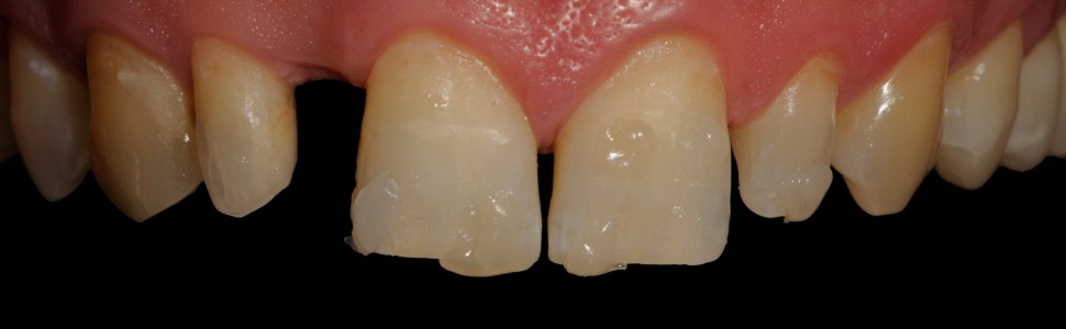 Odbudowa bezpośrednia zębów siecznych szczęki z wykorzystaniem dwóch rodzajów indeksów silikonowych