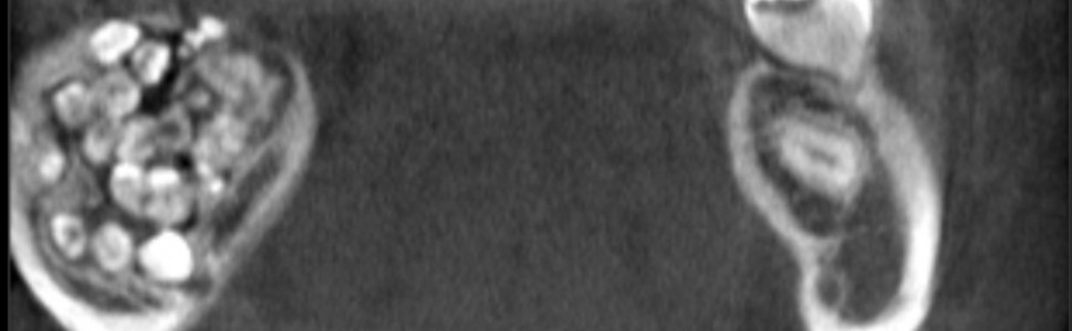 Zębiak. Opis przypadku u 12-letniego dziecka 