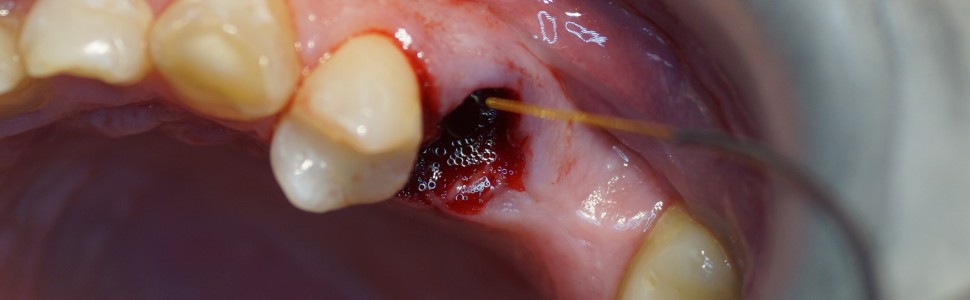 Stabilizacja skrzepu w zębodole poekstrakcyjnym za pomocą lasera diodowego 980 nm