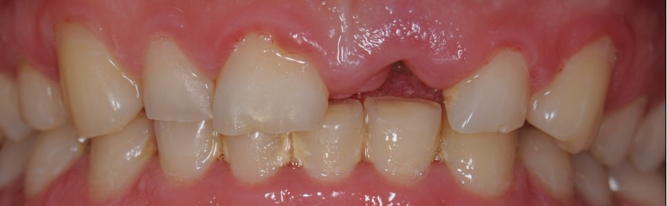 Kompromisowa odbudowa zębów siecznych szczęki z wykorzystaniem włókna szklanego w celu uzupełnienia utraconego zęba