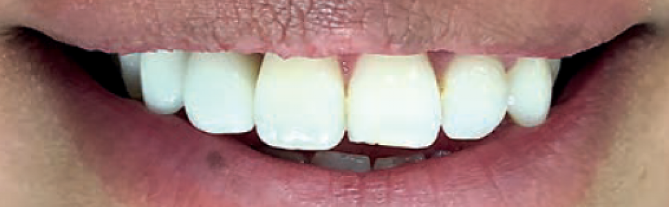 Planowanie leczenia endodontycznego od A do Z. Klucz do długotrwałego sukcesu. Opis przypadku
