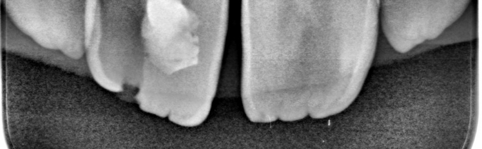 Leczenie regeneracyjne niedojrzałych  zębów stałych. Geneza, istota, perspektywy kliniczne