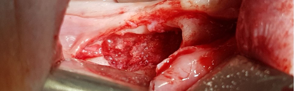 REPORTAŻ KLINICZNY: Zastosowanie dwufazowego siarczanu wapnia  w jedno‑ i dwuetapowym leczeniu torbieli zębopochodnych. Opis przypadku