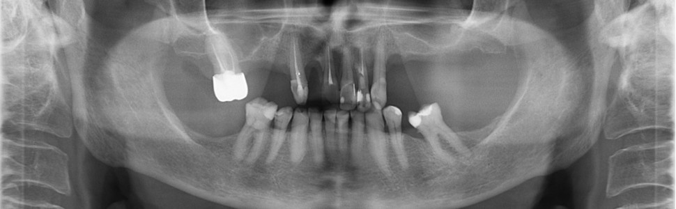 Ponowne leczenie endodontyczne dwukorzeniowego zęba 22. Opis przypadku