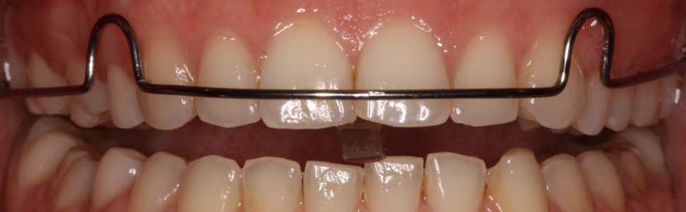 Diagnostyka funkcjonalna w procesie planowania leczenia u pacjentów z zaburzeniami skroniowo‑żuchwowymi oraz nieprawidłowościami okluzji