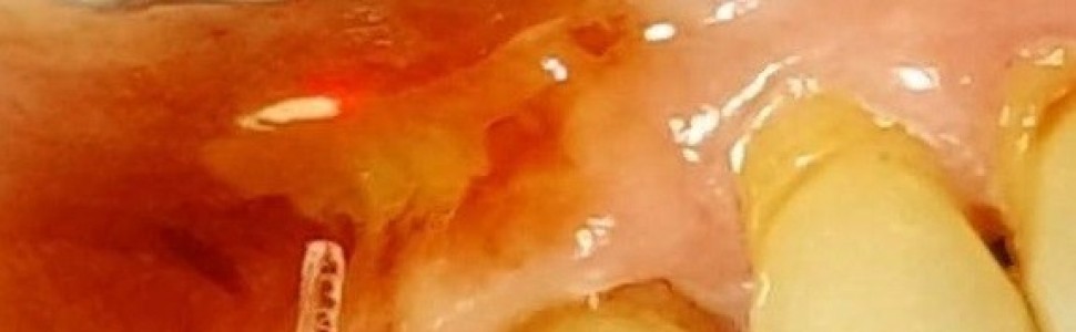 Wykorzystanie lasera Er:YAG w leczeniu liszaja płaskiego jamy ustnej. Opis przypadku