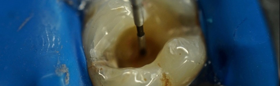 Odbudowa zębów bocznych. Techniki kliniczne stosowane w rekonstrukcjach bezpośrednich