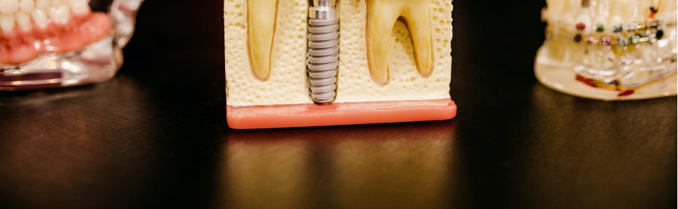 Profesjonalna profilaktyka stomatologiczna u pacjentów dorosłych