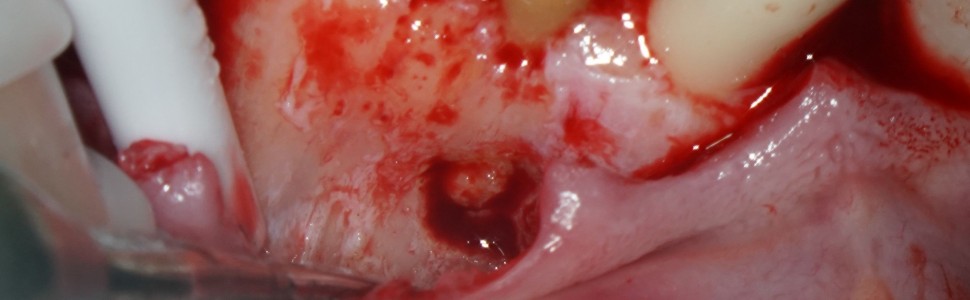 ARTYKUŁ Z FILMEM: Resekcja wierzchołka korzenia z użyciem lasera po powtórnym leczeniu endodontycznym. Opis przypadku