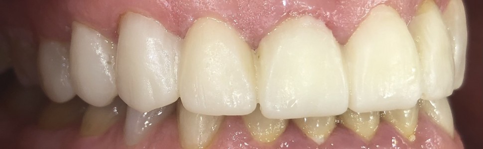 REPORTAŻ KLINICZNY: Wspomagana komputerowo odbudowa zębów w strefie estetycznej. Opis przypadku