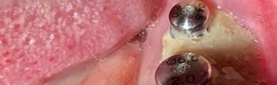 Martwica kości żuchwy zaopatrzonej implantami w przebiegu terapii bisfosfonianami