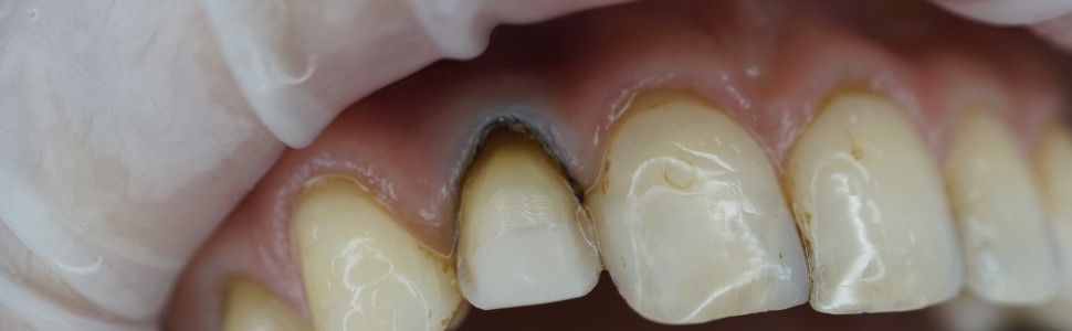 REPORTAŻ KLINICZNY: Naprawa uszkodzonej licówki ceramicznej z zastosowaniem odłamanego fragmentu i materiału kompozytowego