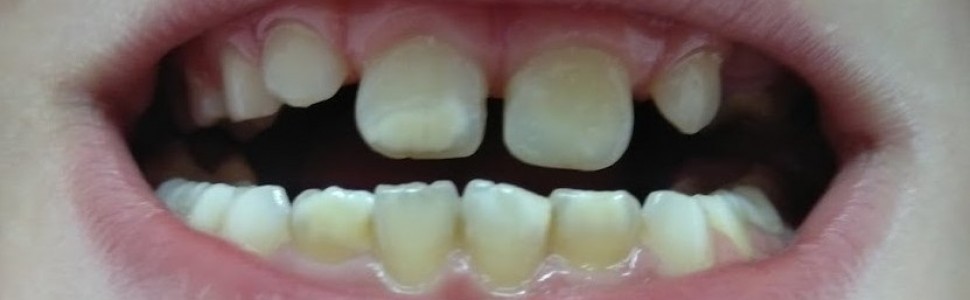 Hipomineralizacja trzonowcowo‑siekaczowa. Opis przypadku