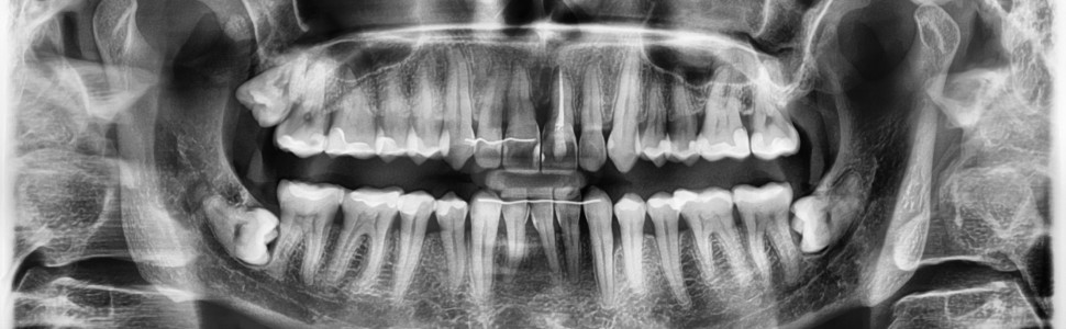 Zastosowanie ekstruzji ortodontycznej do rekonstrukcji ubytków tkanek przyzębia. Opis przypadku