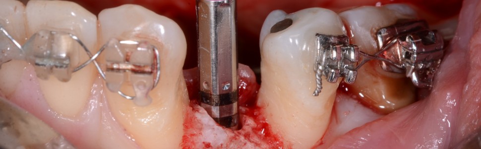 Wielospecjalistyczne leczenie pacjentów z zapaleniem przyzębia. Opis przypadku