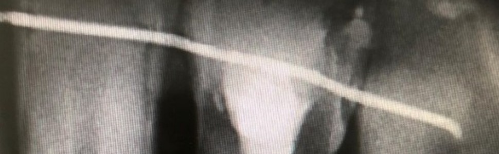 Zespół endodontyczno‑periodontologiczny i jego wpływ na przyzębie Metodyka leczenia z zastosowaniem lasera – opis przypadku