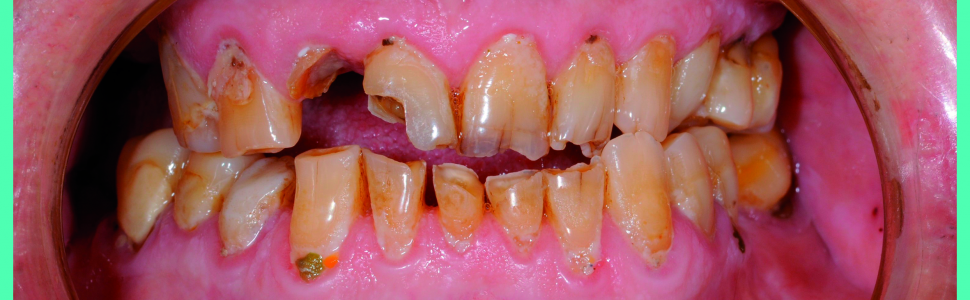 Szynoterapia i przebudowa zwarcia w rehabilitacji implantoprotetycznej pacjenta z dysfunkcją układu ruchowego narządu żucia