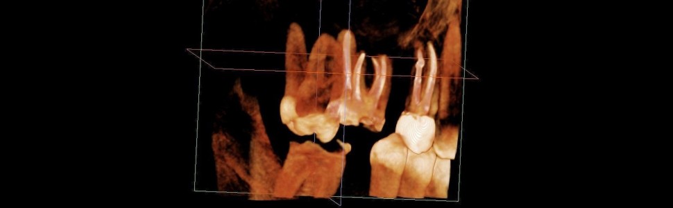 Kryteria oceny prawidłowości leczenia endodontycznego jako etapu przygotowawczego do leczenia protetycznego. Na podstawie piśmiennictwa i doświadczeń własnych
