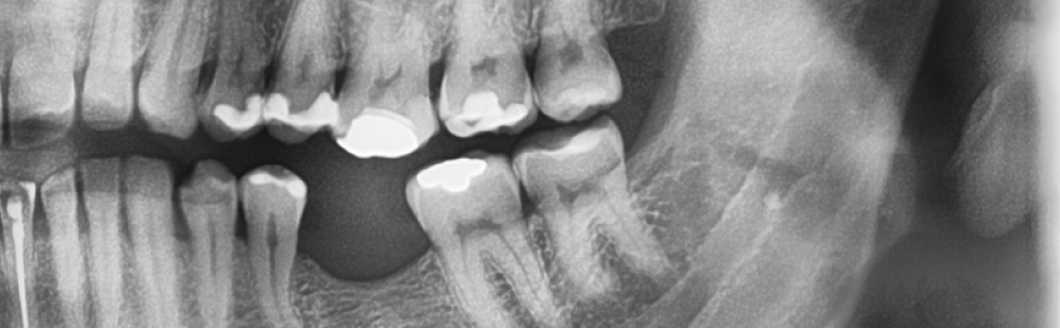 Uzupełnienie braku zęba 36, a konieczność leczenia kanałowego zęba 26 z powodu Efektu Godona – leczenie kanałowe jako jeden z etapów leczenia u pacjentów z zaburzeniami okluzji