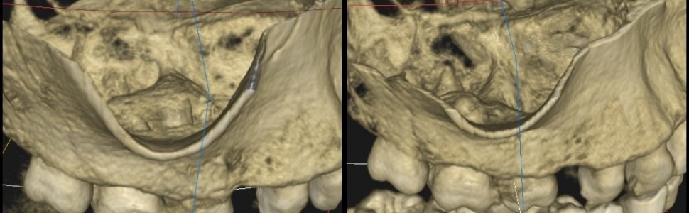 Powtórna endodoncja mikroskopowa z mikrochirurgią endodontyczną zęba 16 w czteroletniej obserwacji – opis przypadku