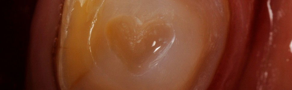 REPORTAŻ KLINICZNY. Z miłości do adhezji. Kompozytowa rekonstrukcja korony zęba trzonowego po leczeniu kanałowym