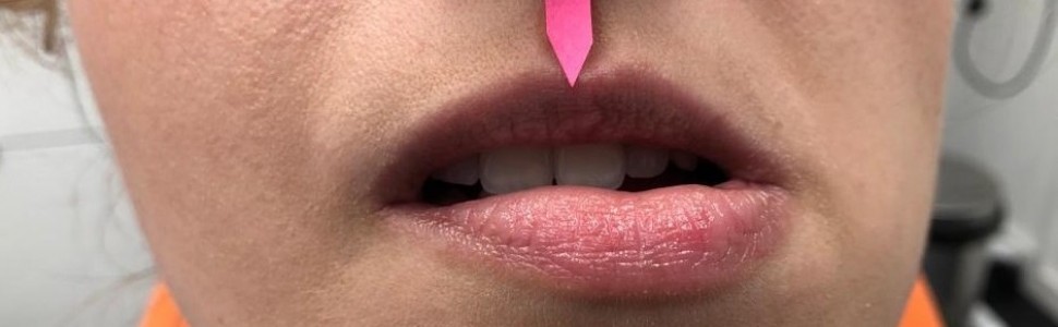 Syndrom Ernesta – zapalenie przyczepu więzadła rylcowo-żuchwowego