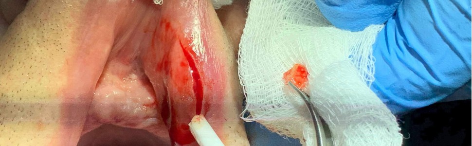 Akrylowe ciało obce w wardze górnej – opis przypadku