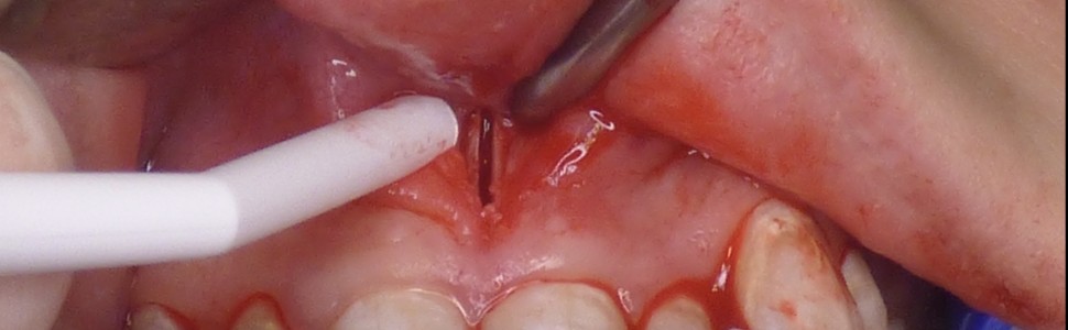 REPORTAŻ KLINICZNY. SARPE jako technika chirurgiczna ekspansji szczęki u pacjentów dojrzałych szkieletowo 