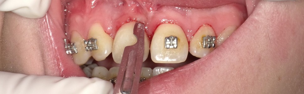 REPORTAŻ KLINICZNY. Dwuetapowa korekta tkanek miękkich wspomagająca leczenie ortodontyczne wprowadzające do łuku zatrzymany ząb sieczny przyśrodkowy