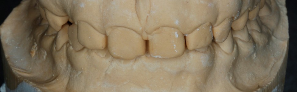 SPECJALISTA RADZI: Planowanie łuku zębowego na podstawie szerokości zęba siecznego przyśrodkowego szczęki