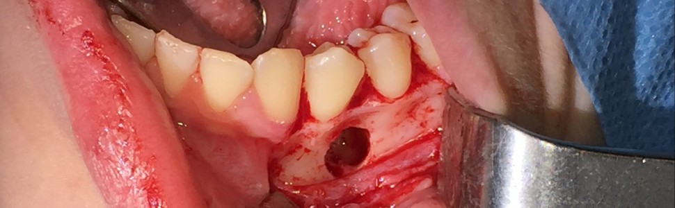 Mnogie zęby nadliczbowe żuchwy. Opis przypadku