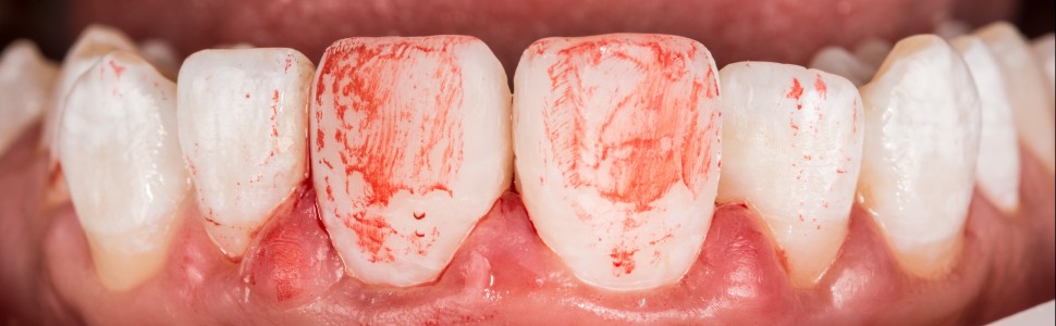 REPORTAŻ KLINICZNY. Bezpośrednia biomimetyczna odbudowa kompozytem zębów siecznych po urazie