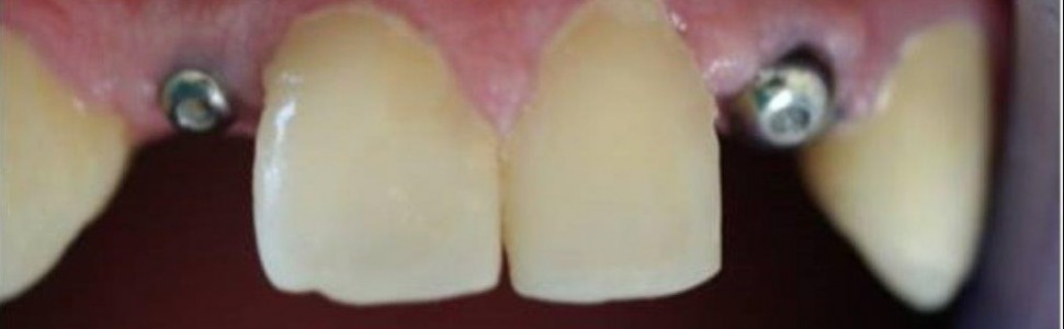 Uzupełnienie wrodzonego braku zawiązków stałych zębów siecznych bocznych w szczęce...