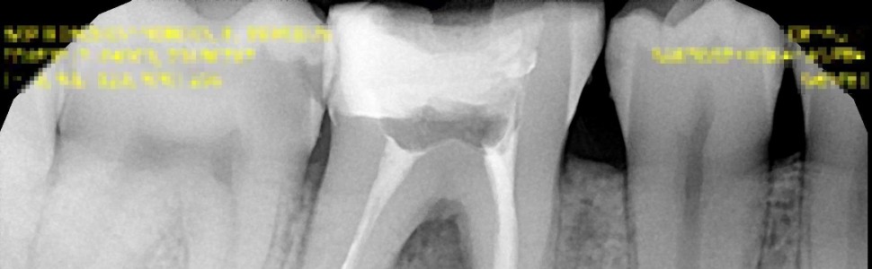 Leczenie endodontyczne zęba 46 z przewlekłym ropnym zapalaniem tkanek okołowierzchołkowych – opis przypadku