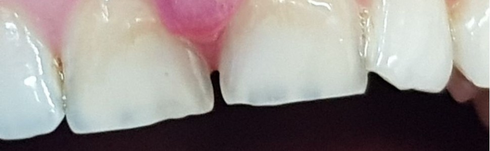 Ciążowe zapalenie dziąseł. Przegląd piśmiennictwa