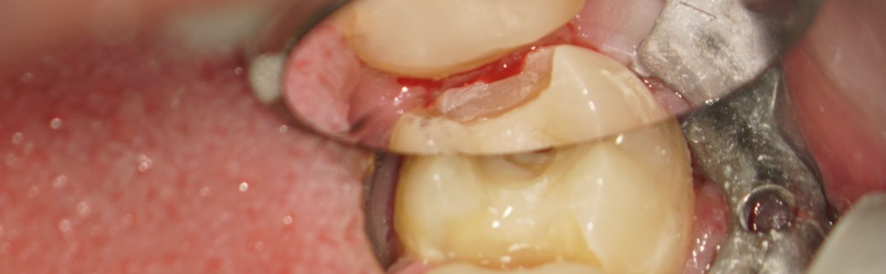 ARTYKUŁ Z FILMEM: Opis przypadku leczenia kanałowego zęba 37 z przewlekłym stanem (...)