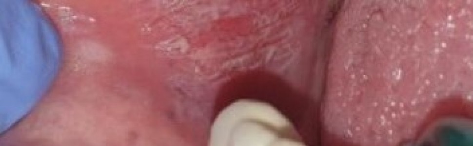 Leczenie postaci zanikowo-nadżerkowej liszaja płaskiego (...) 