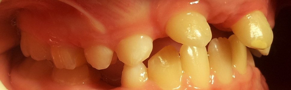 Zęby dwoiste. Terapia wielospecjalistyczna pacjenta