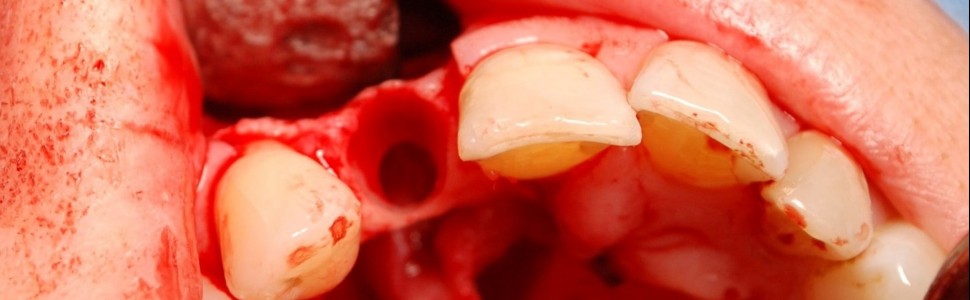 Leczenie torbieli korzeniowej szczęki z zastosowaniem materiału kościozastępczego (...)