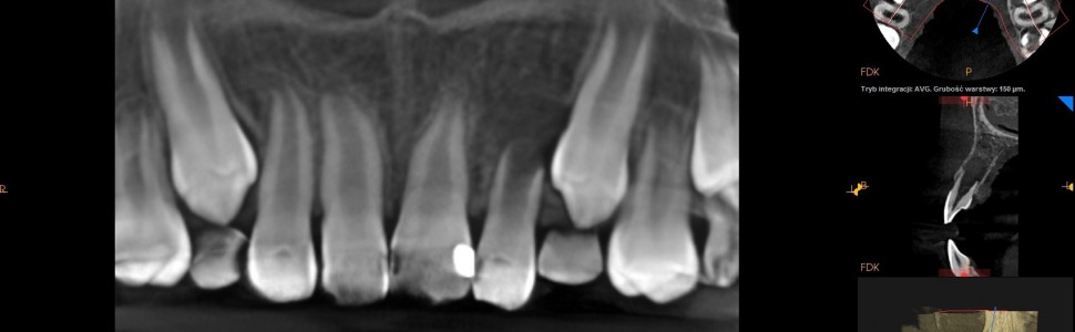 REPORTAŻ KLINICZNY. Leczenie endodontyczne zęba z niezakończonym rozwojem korzenia (...)