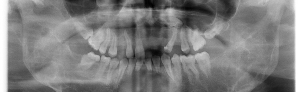 Wieloletnie obserwacje zmian w cherubizmie na podstawie zdjęć rentgenowskich (...)