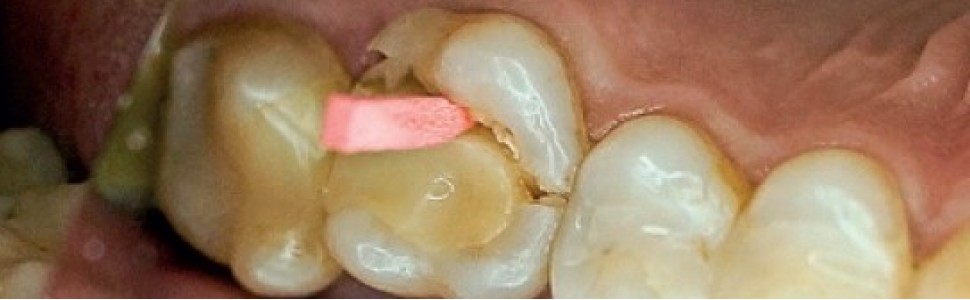 Adhezyjne uzupełnienia pośrednie w złamanych zębach bocznych – analiza problemu klinicznego