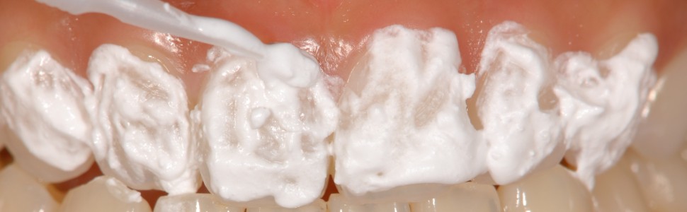 SPECJALISTA RADZI: Znoszenie nadwrażliwości zębów, szczególnie u pacjentów po zabiegu wybielania zębów