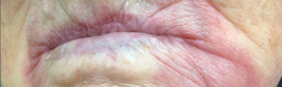 Kandydoza jamy ustnej – jak ją rozpoznać i prawidłowo leczyć?