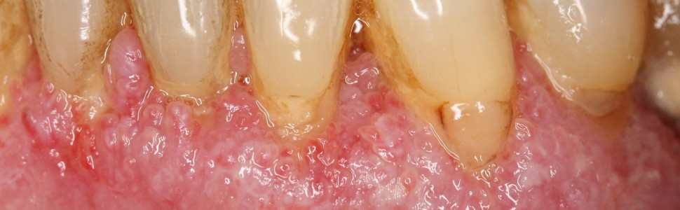 Pemfigoid błon śluzowych – trudności diagnostyczno‑lecznicze (...)