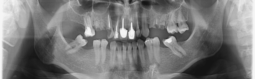 Potencjał naprawczy tkanek okołowierzchołkowych zębów (...)