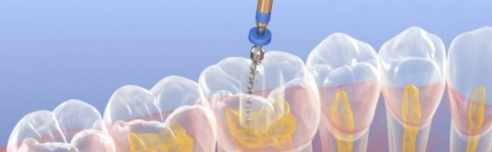 Powikłania leczenia endodontycznego podczas opracowywania kanałów (...)